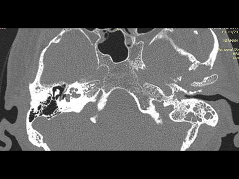 How to Read HRCT Temporal Bone : All Basics in Detail