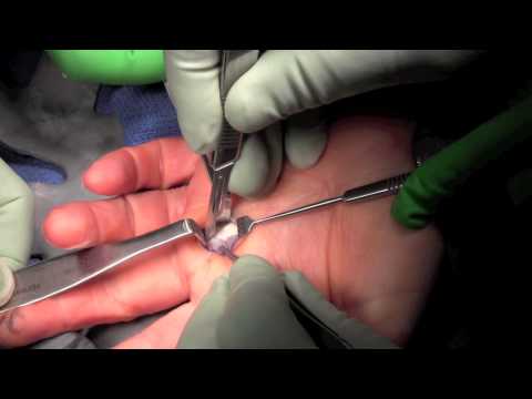 Operacja palca trzaskającego (A1)