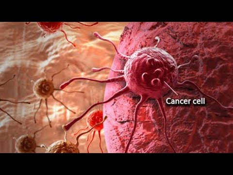 Mos i neglizhoni! Kjo është forma më tinëzare e kancerit, kur keni këto simptoma shkoni urgjent tek…