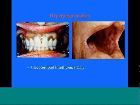 Adrenal Insufficiency