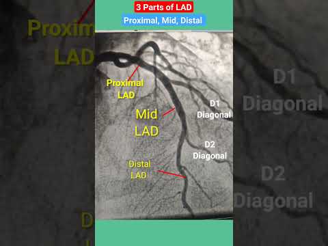 Proximal, mid, distal LAD ( Left anterior descending artery) #angiography #shorts