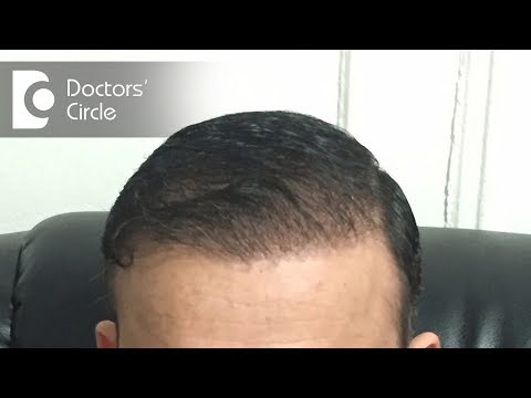 When should I get a hair transplant?- Dr. Surindher D...
