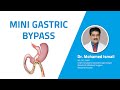 Mini Gastric Bypass Dr Mohammed Ismail MS FICS FMAS Chief Surgeon Moulana Hospital