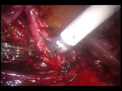 Robotic-Assisted Removal Of The Stone From The Ureter