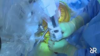 Dr. Stefan Kreuzer performs Total Knee Arthroplasty using the Think Surgical TCAT (No Audio)