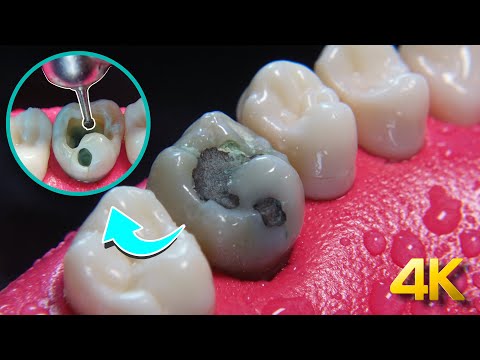 Teeth capping process