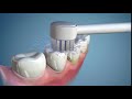 How to Use the Waterpik™ Toothbrush Tip