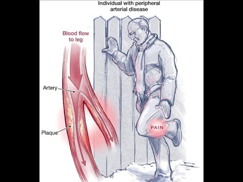 Prostate tumor diagnosis