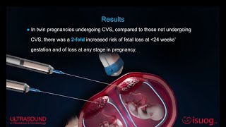 #UOG video abstract on chorionic villus sampling in twin pregnancy