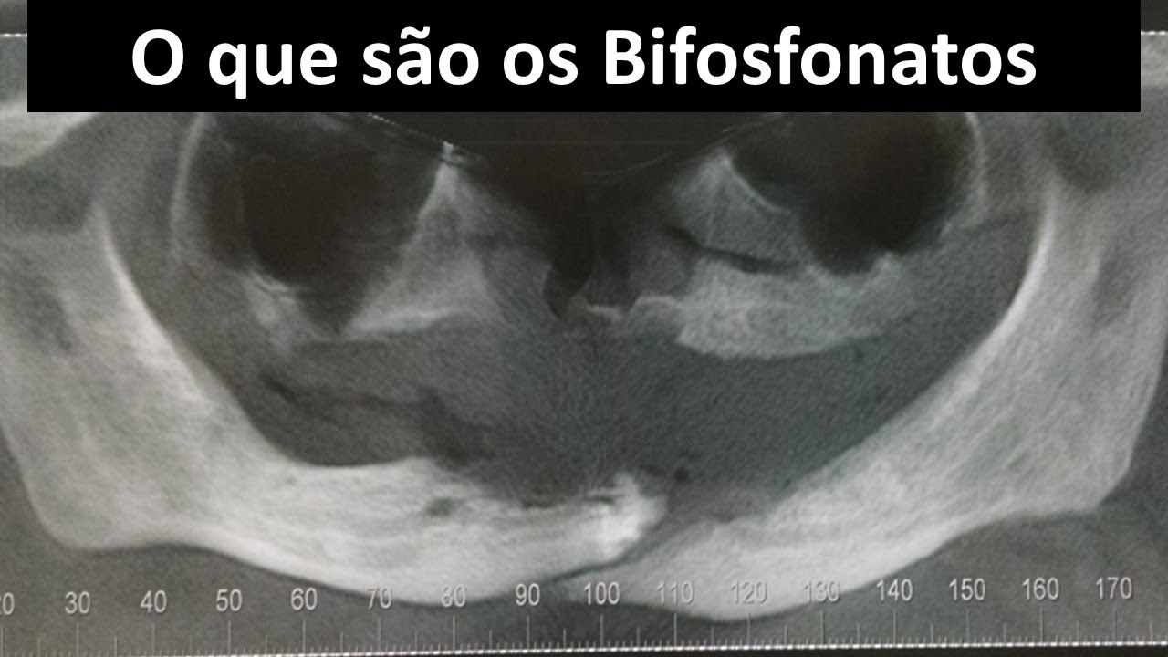 O que são os Bifosfonatos | Odontologia | Dra Bianca Rosa