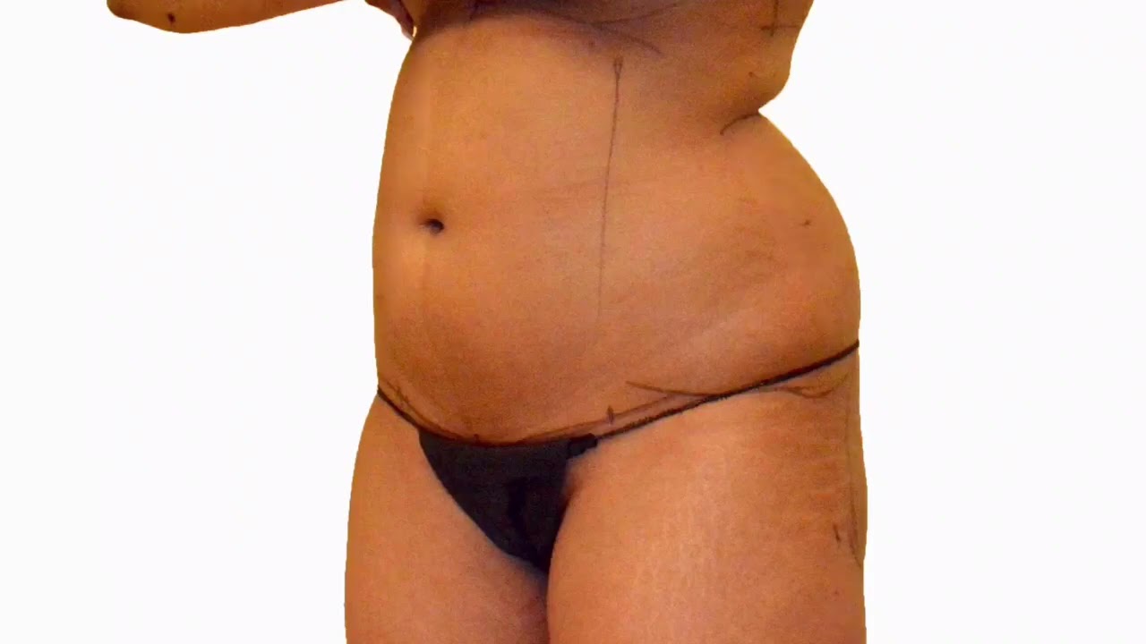 Transform Your Body: Stunning Liposuction Before and After Visual