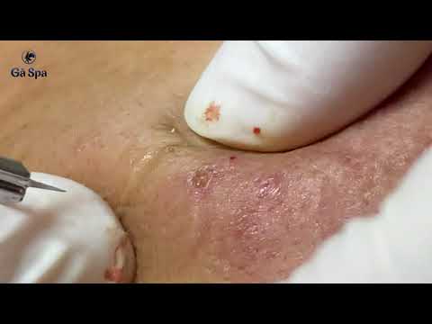 Acne Treatment in Thu Duc City | Ga Spa 31.03.2022