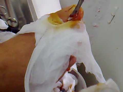 comment guerir ongle incarné