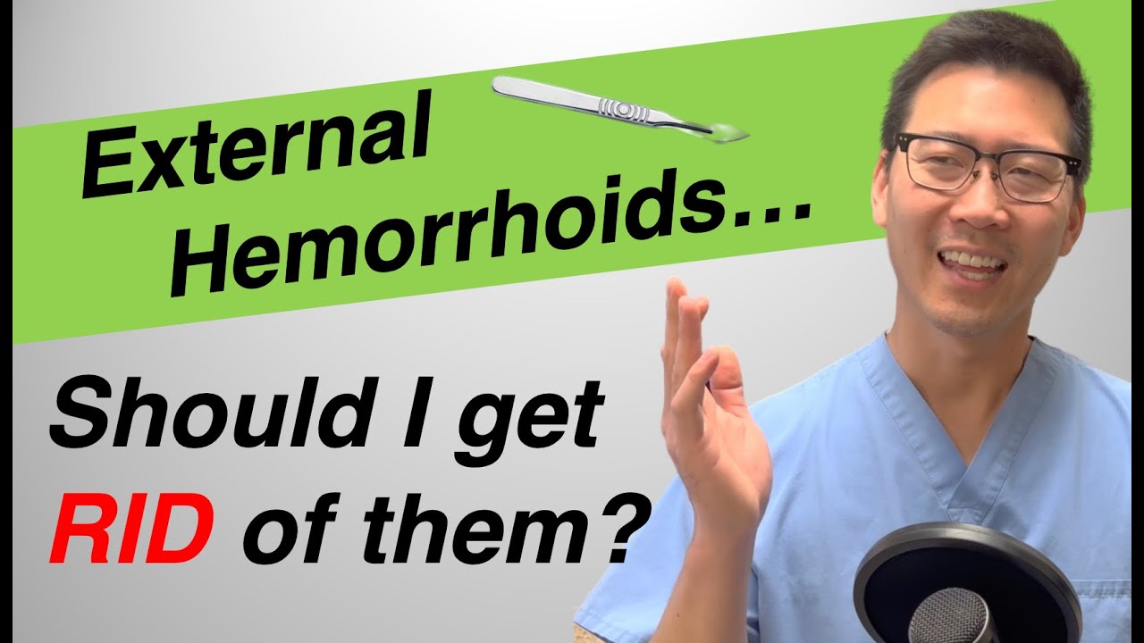 External hemorrhoid treatment: Should I REMOVE or LEAVE them?