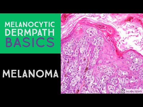 Melanocytic Dermpath Basics: Melanoma