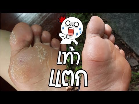 โรคสะเก็ดเงินที่เล็บหนึ่ง กลากประสาทในเด็ก