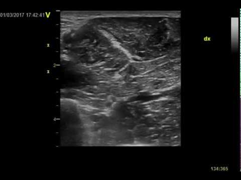 Anterior interosseous with median nerve at pronator exit. Normal nerve ultrasound.