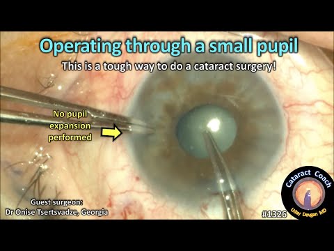 CataractCoach 1326: operating through a small pupil