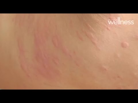 What are hives and how can you treat them?