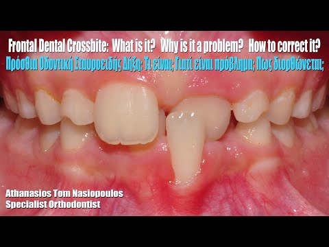 Frontal Crossbite