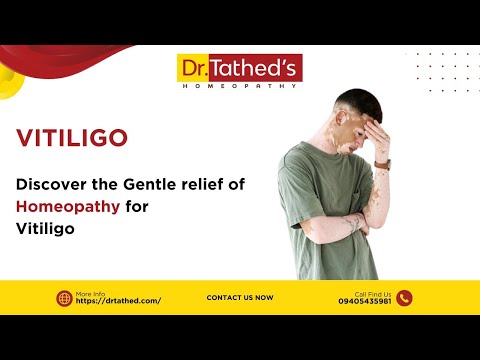 Vitiligo Patient Success Story 1