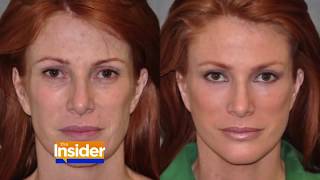 SuperModel Angie Everhart AWAKE facelift after cancer - Dr. Ben Talei - EXCLUSIVE Insider Interview