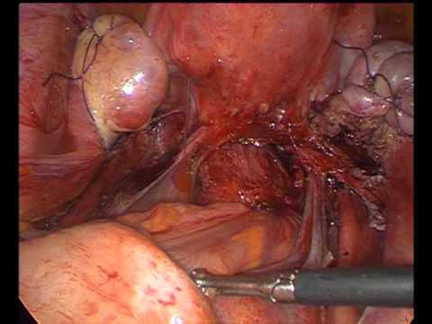 Colo-Rectal Endometriosis in a young virgin patient, edited full version