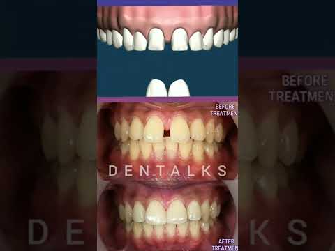 #veneers Worried about Gap between Front Tooth ?? Dental Veneers | Patient Education Animation