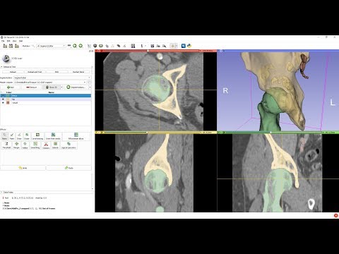 Femur segmentation using masked region growing in 3D Slicer
