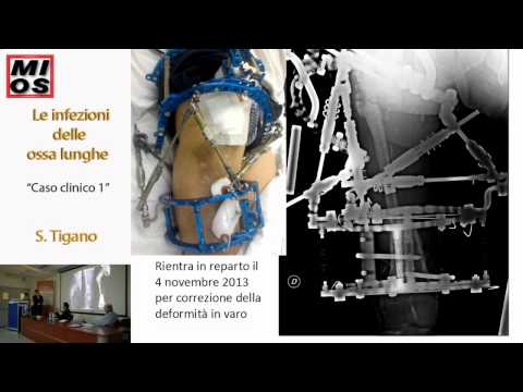 Gialuronka a verifiche congiunte Peggio scoliosi o osteocondrosi
