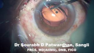 new acriol platform IOL by Caregroup