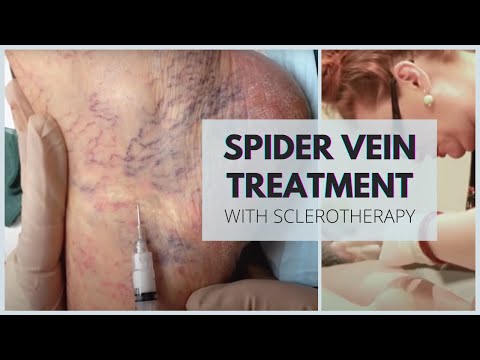 Sclerotherapy - Spider Veins Treatment at Vein Health Vein Clinic