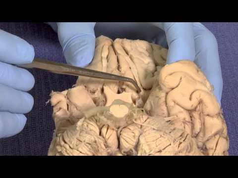 Olfactory: Neuroanatomy Video Lab - Brain Dissections