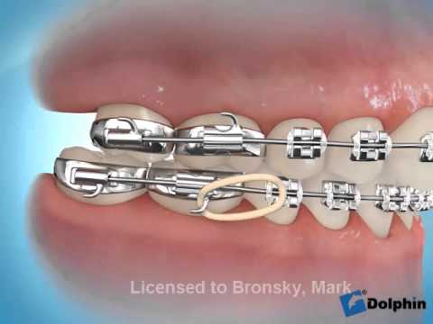 Conseil vidéo orthodontie