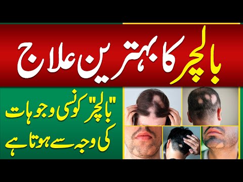 Patchy Hair Loss - Balchar Ka ilaj - Types of Alopecia Signs, Causes and Treatment - Balo Ka Girna