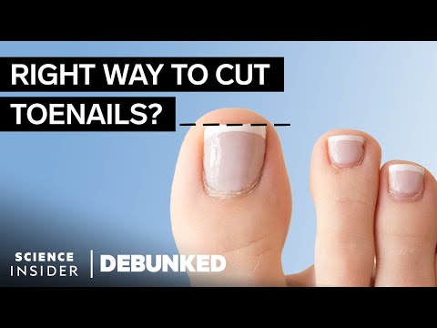 What Really Causes Bunions? - Foot Health Myths Debunked