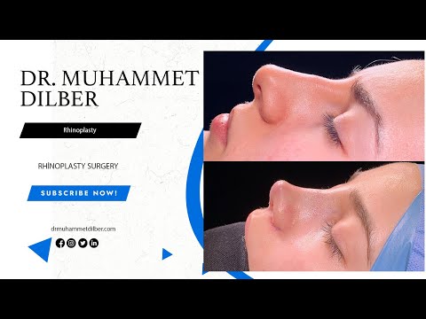 Rhinoplasty Result l Nosejob Results l Dr Muhammet Dilber