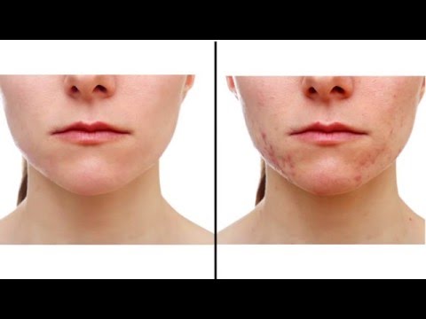 Photoshopでニキビを消す方法 (How to remove acne in Photoshop)