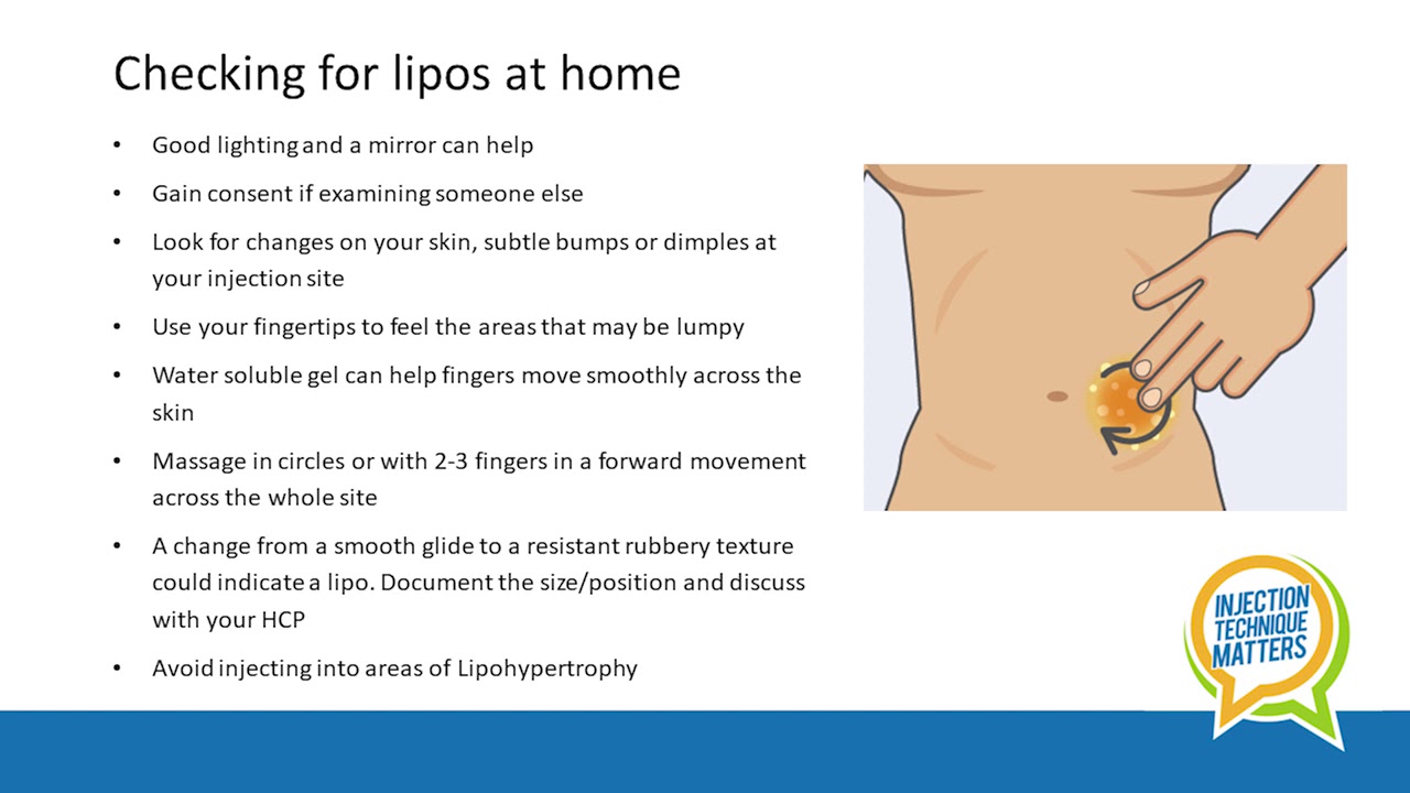 Debbie Hicks | Lipohypertrophy | Injection Technique Matters - YouTube