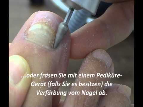 Wie mit gribkom auf den Füssen zu kämpfen Für die Prophylaxe von gribka der Nägel