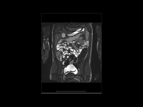 Crohn's Disease - Active Inflammation Overview