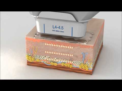 Ultraformer  HIFU Facial Lifting Treatment