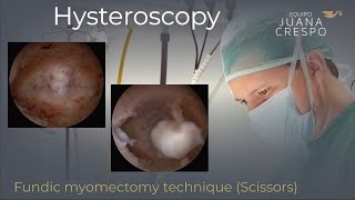 Fundic myomectomy (with scissors)