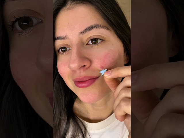 Vídeo relacionado con IROHA NATURE - Pack On The Go Parches Granos Hidrocoloides (33 uds) + Estuche con Espejo | Ácido Salicílico + Árbol de Té + CICA | SOS Transparentes + FUN | K-Beauty