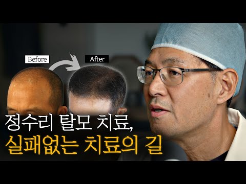 정수리탈모 모발이식은 이렇게 해야 실패가 없습니다