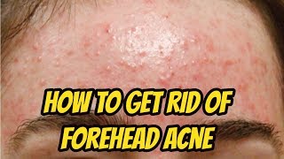 How to Get Rid of Forehead Acne and Bumps Fast at Home Overnight