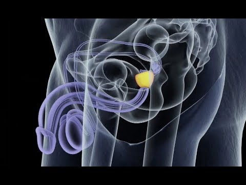 PROSTATE : LE DOSAGE DU PSA C'EST QUOI
