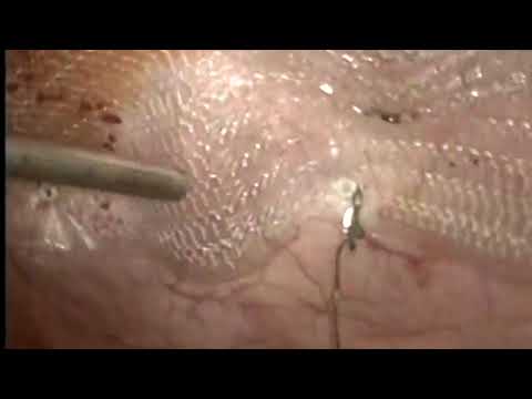 2P CMC ClearMesh Composite - Laparoscopic surgical approach.