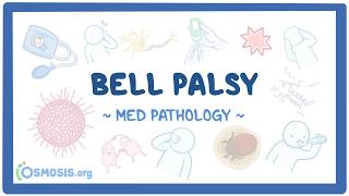 Bell palsy