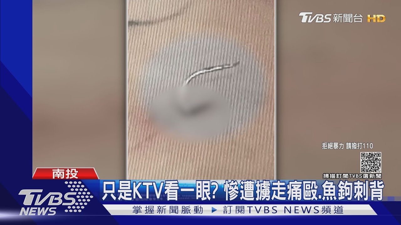 只是KTV看一眼？　慘遭擄走痛毆、魚鉤刺背